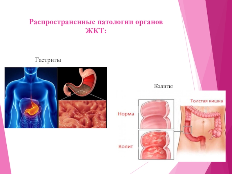 Проект на тему гастрит