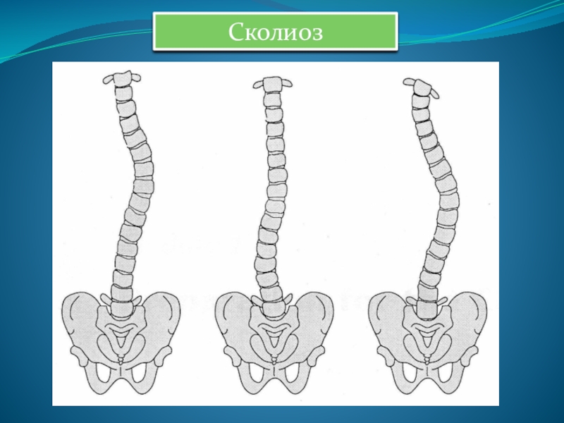 Проект сколиоз 9 класс