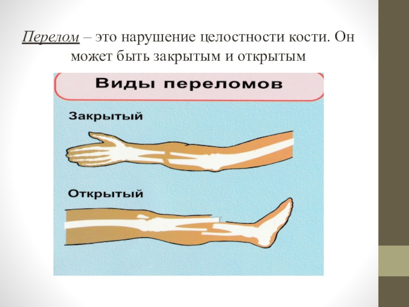 Презентация первая помощь при травмах опорно двигательной системы