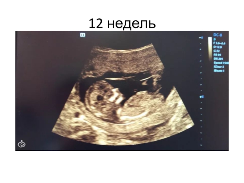 Скрининг 12 недель беременности фото