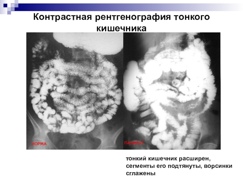Контрастная рентгенография тонкого кишечникатонкий кишечник расширен, сегменты его подтянуты, ворсинки сглажены