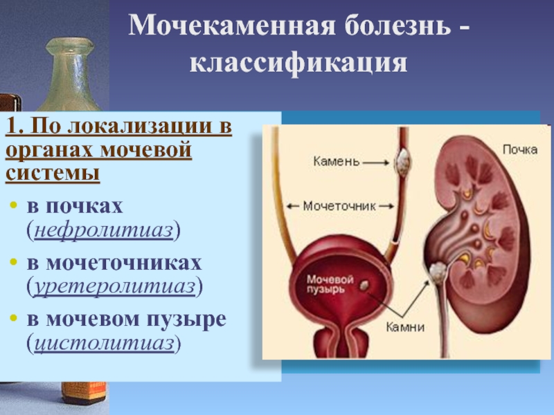 Мочекаменная болезнь - классификация1. По локализации в органах мочевой системыв почках (нефролитиаз)в мочеточниках (уретеролитиаз)в мочевом пузыре (цистолитиаз)