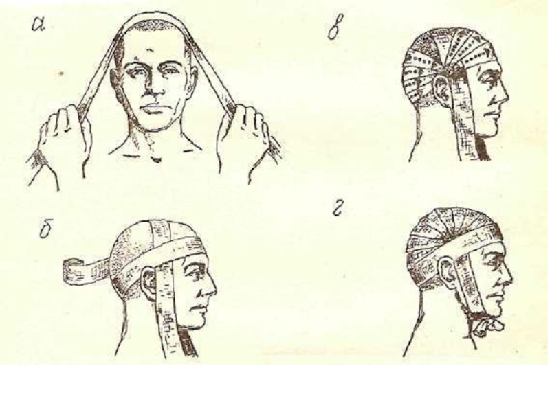 Техника наложения повязки чепец. Бинтование головы чепец. Наложение повязки на голову чепец. Перевязка чепец техника.