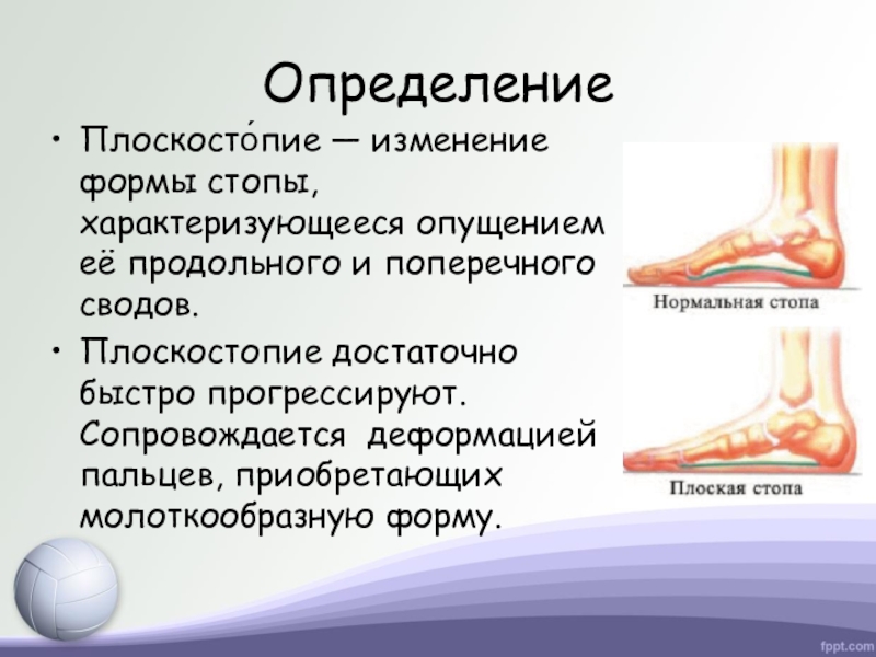 Изменение формы стопы. Вальгус вальгус плоскостопие. Плоскостопие поперечного свода стопы. Поперечное плоскостопие 3 степени. Поперечное и продольное плоскостопие классификация.