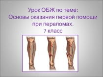Презентация к уроку ОБЖ Оказание первой помощи при переломах.