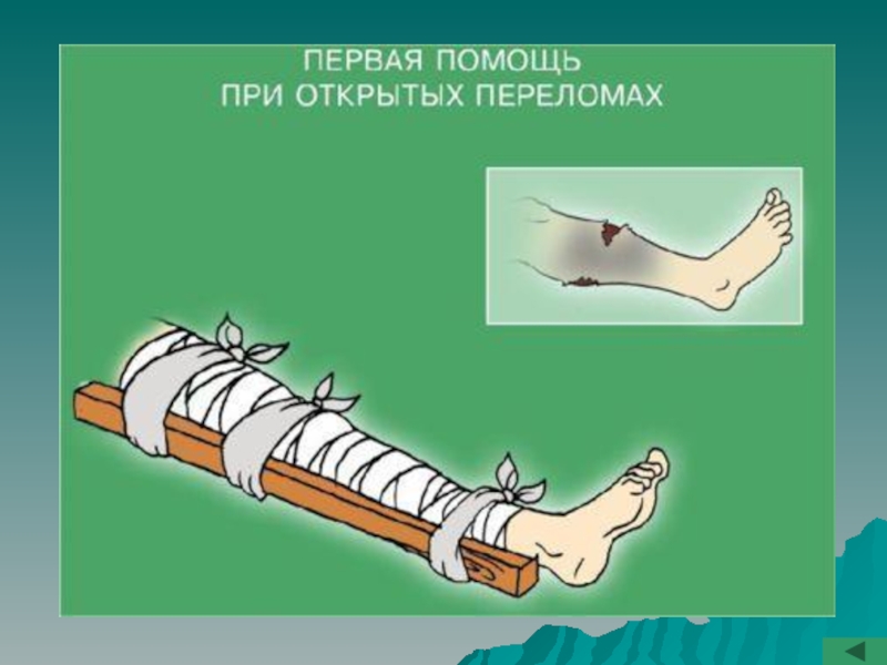 Первая помощь при закрытых переломах презентация