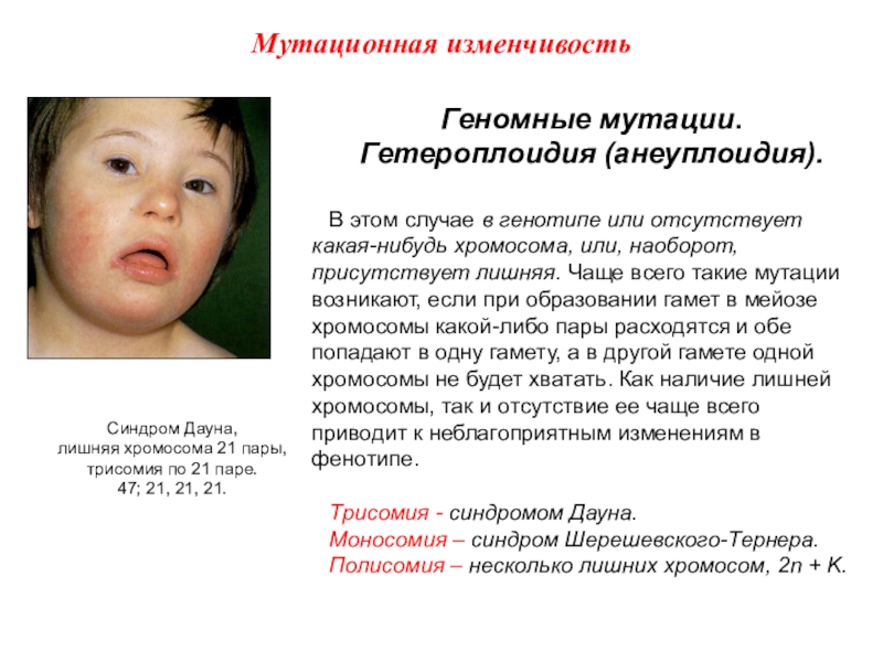 Хромосомные заболевания дауна. Геномные мутации анеуплоидия. Синдром Дауна обусловлен мутацией. Синдром Дауна Тип мутации. Синдром Дауна вызывается геномной мутацией.