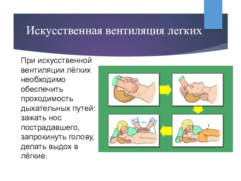 Искусственную вентиляцию легких необходимо