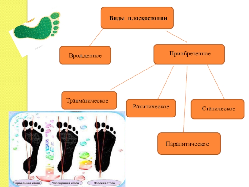 Виды плоскостопия картинки