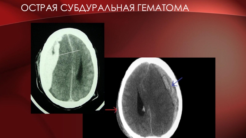 Субдуральная гематома. Пластинчатая субдуральная гематома кт. Конвекситальная субдуральная гематома. Субдуральная гематома 10мл. Краниография субдуральная гематома.