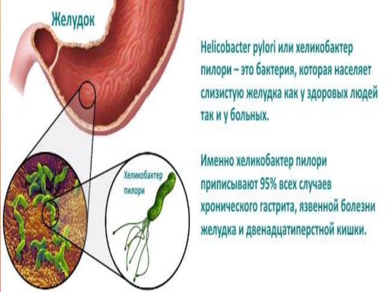 Helicobacter pylori síntomas lengua