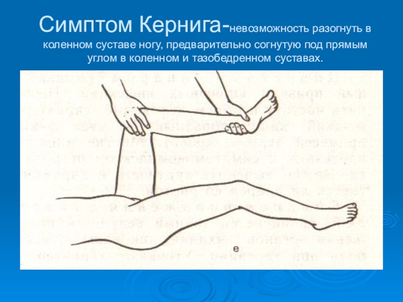 Симптом кернига. Положительный симптом Кернига выявляется. Кернига симптом Кернига.