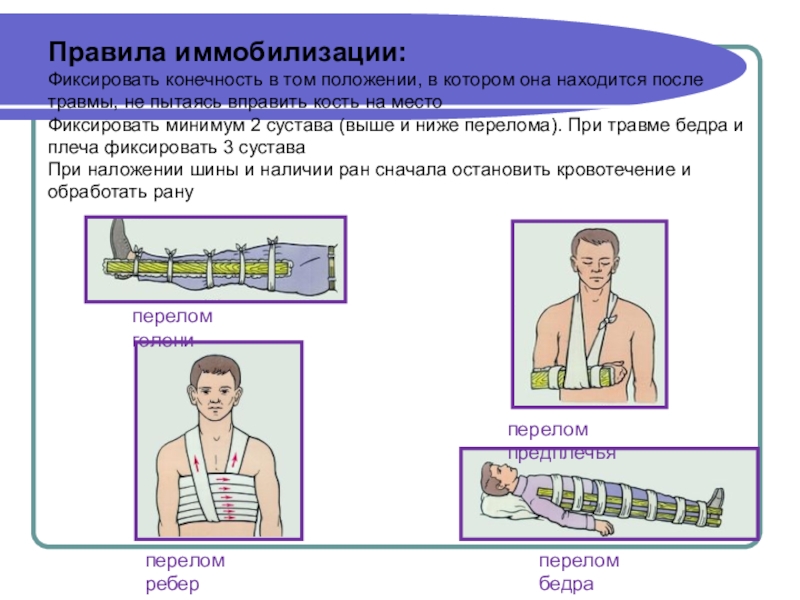 Транспортную иммобилизацию выполняют. Иммобилизация конечности. Шины для иммобилизации конечностей. Иммобилизация при травмах конечностей. Иммобилизация при переломе нижней конечности.