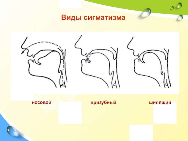 Способ артикуляции. Межзубный сигматизм шипящих звуков. Носовой сигматизм. Носовой сигматизм шипящих звуков. Сигматизм свистящих звуков.