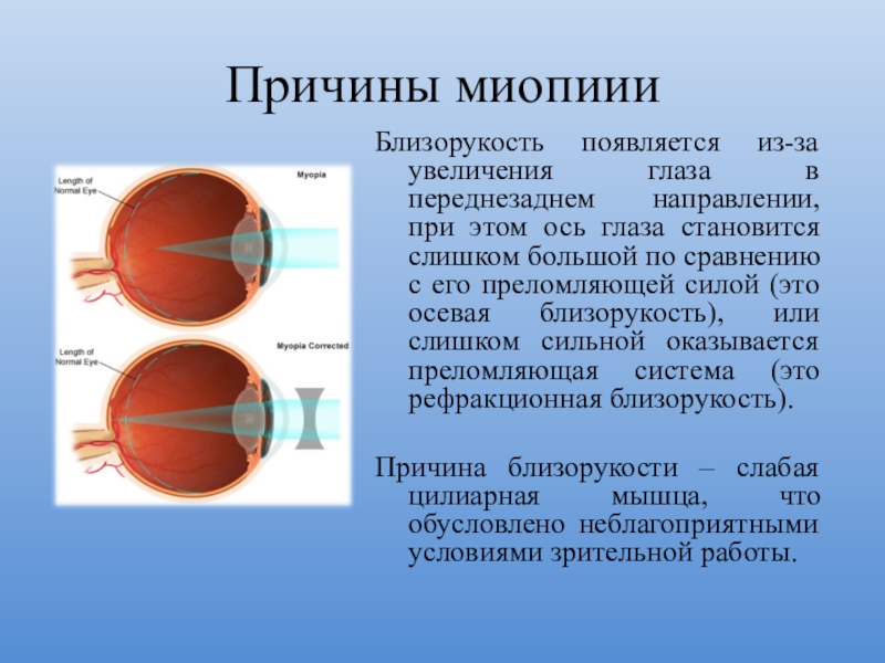 Дальнозоркость презентация по биологии