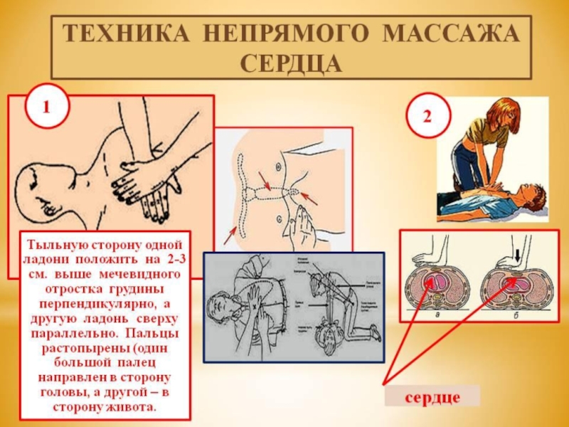 Прямой массаж сердца. Порядок проведения наружного непрямого массажа сердца. Техника выполнения наружного массажа сердца у взрослых. Непрямой массаж сердца техника техника. Непрямой массаж сердца техника выполнения 1.