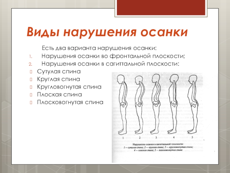 Главной нарушении осанки является. Типы нарушения осанки. Нарушение осанки в сагиттальной плоскости. Нарушение осанки во фронтальной плоскости. Три степени нарушения осанки.