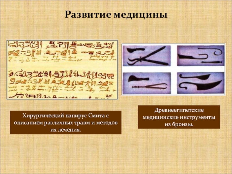 Древнеегипетские медицинские инструменты из бронзы.Развитие медициныХирургический папирус Смита с описанием различных травм и методов их лечения.