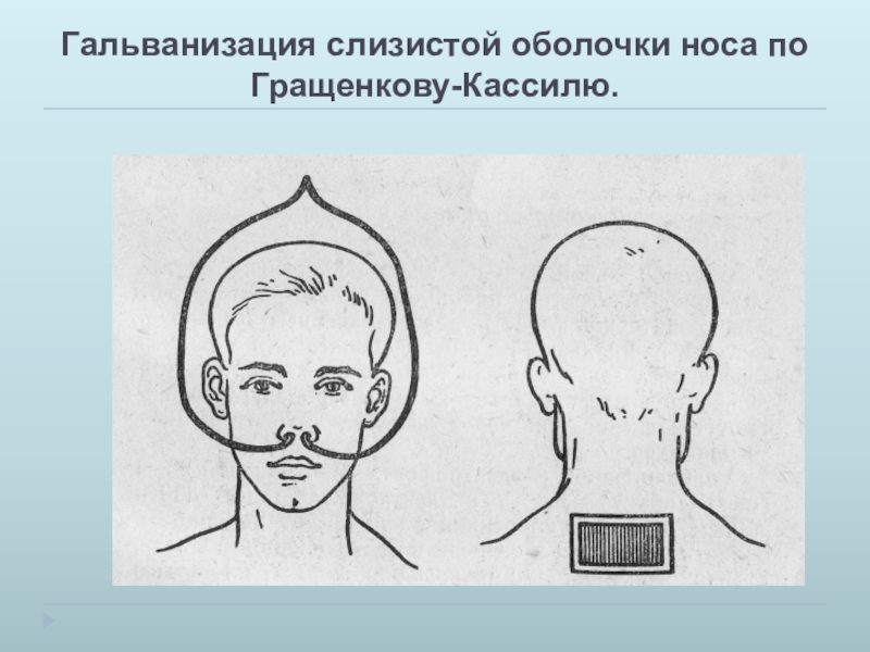 Гальванизация. Гальванизация слизистой оболочки носа по Гращенкову Кассилю. Гальванизация по Бергонье. Электрофорез по Кассилю. Эндоназальная гальванизация.