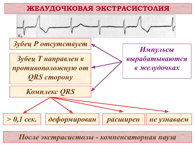 Желудочковая экс. Желудочковая экстрасистолия. Желудочковые экстрасистолы. Желудочковая экстрасистолия причины. Поздняя желудочковая экстрасистолия.