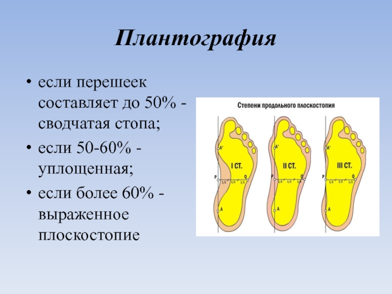 Плоскостопие травматология презентация