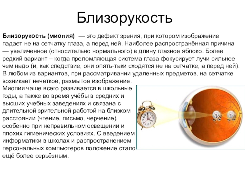 Миопия сетчатки. Близорукость. Зрение близорукость. Заболевания глаз близорукость. Близорукость миопия.