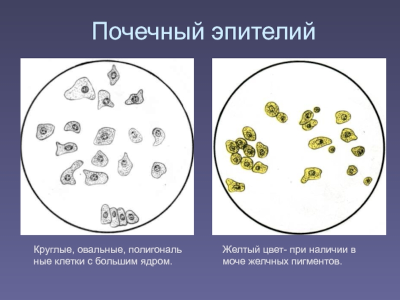 Почечный эпителий в моче фото