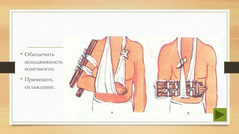 наложение жестких повязок. неподвижные повязки. основное правило иммобилизации при переломах костей конечностей. мостовидные гипсовые повязки. повязка обеспечивающая неподвижность.