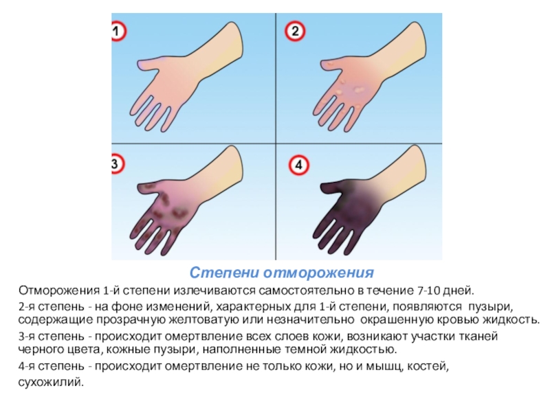 Дореактивный период отморожения. Отморожение 1 2 степени. При отморожениях II степени. Отморожение степени тяжести.