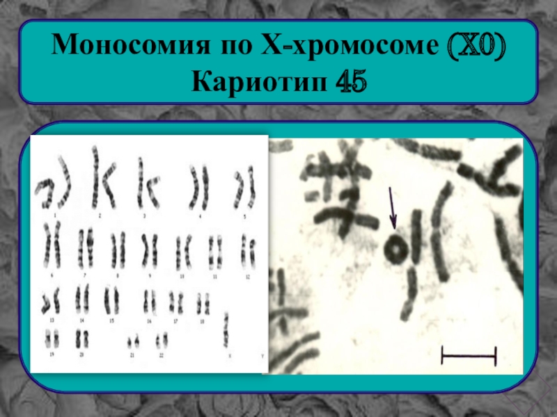 Кариотип 45. Моносомия по х-хромосоме (кариотип 45,х0). Кариотип y0. Кариотип моносомии.