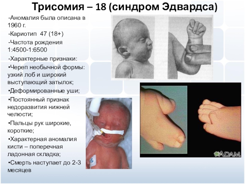 Синдром трисомии х презентация