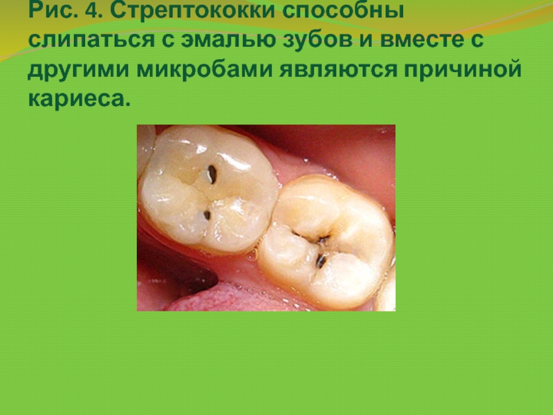 Рис. 4. Стрептококки способны слипаться с эмалью зубов и вместе с другими микробами являются причиной кариеса.