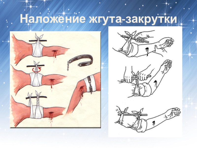 Найди какое кровотечение изображено на рисунке