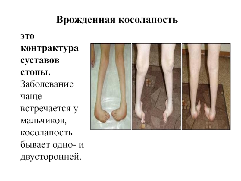 Врожденная косолапость это контрактура суставов стопы. Заболевание чаще встречается у мальчиков, косолапость бывает одно- и двусторонней.