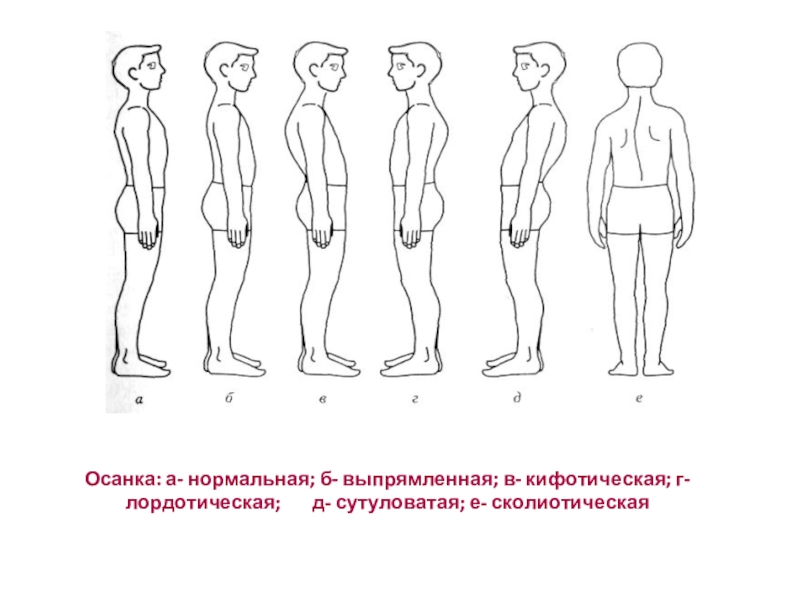 Как называется нарушение осанки изображенное на рисунке 3