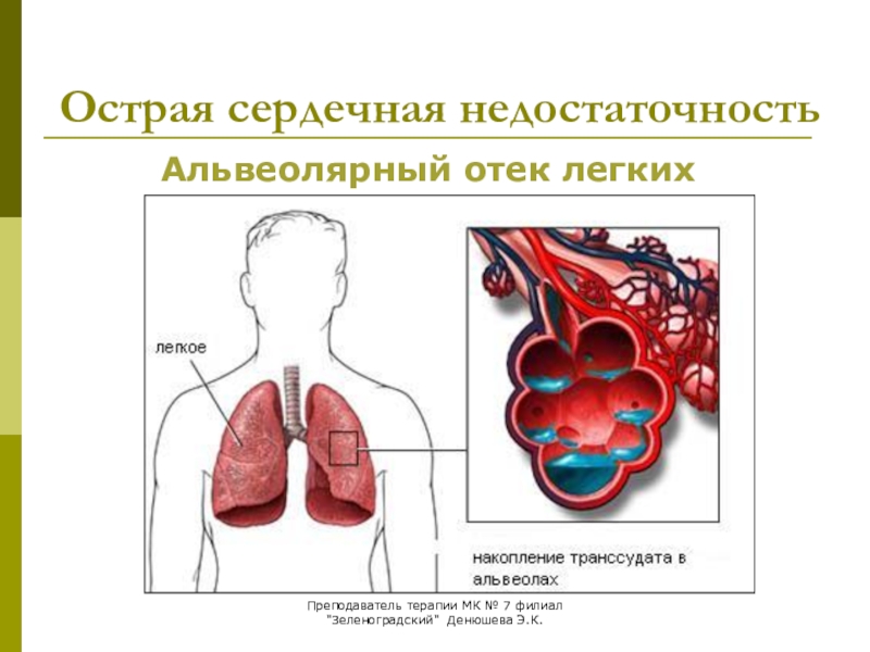 Легочно сердечная недостаточность. Отек легких ХСН сердечная недостаточность. Острая сердечная недостаточность отек легких. ХСН отек легких. Острая сердечная недостаточность при отеке легких.