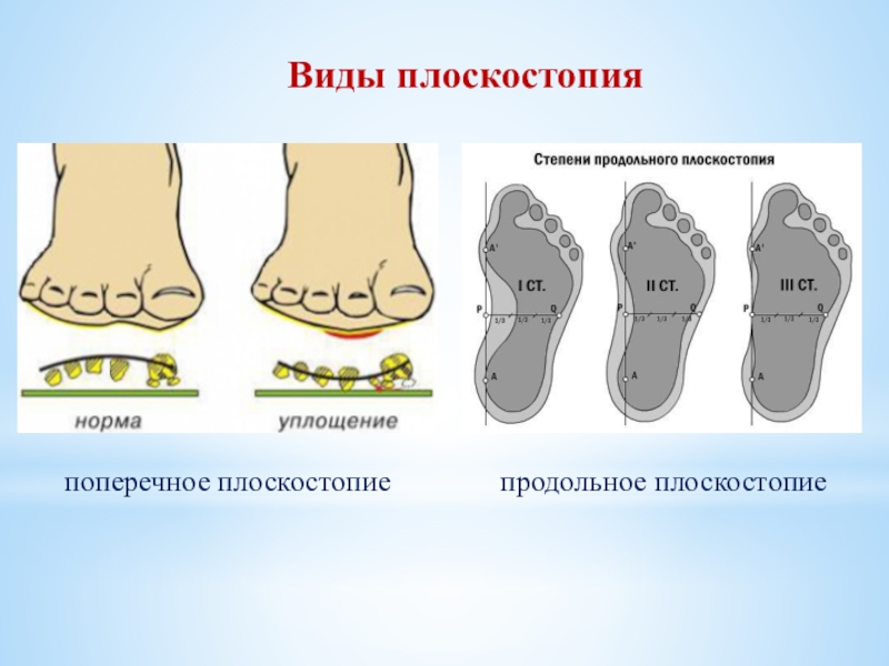 Плоскостопие степени