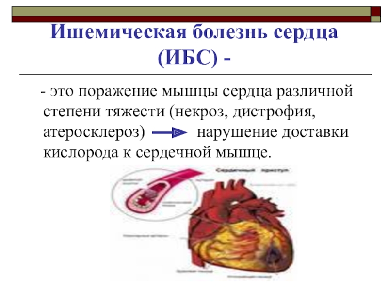 Атеросклероз и инфаркт миокарда различия. Стадии ИБС. Степени болезни сердца. Болезнь сердца 3 стадии. Ишемическая болезнь сердца.