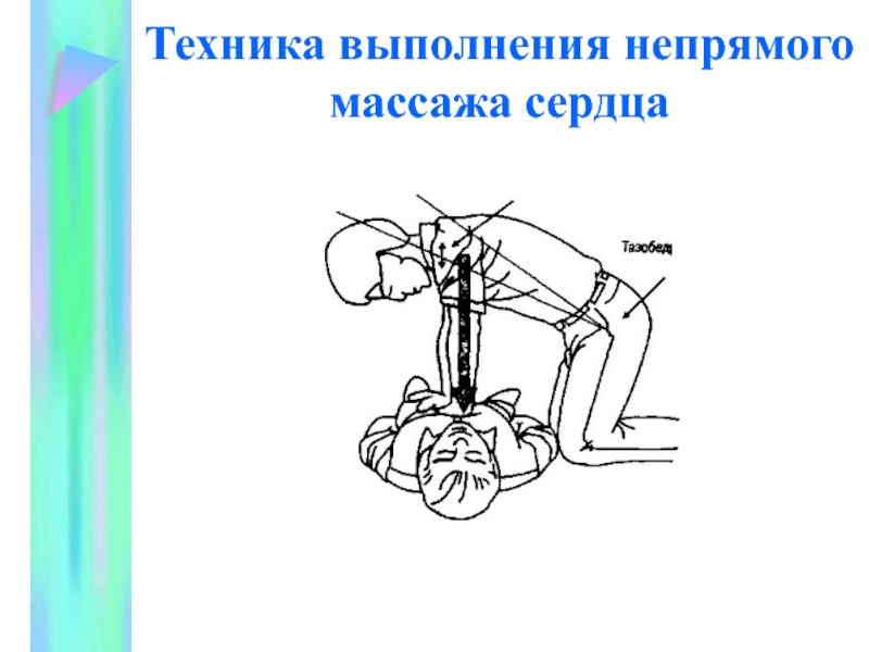 Непрямой массаж сердца схема