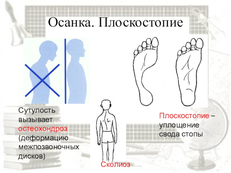 Презентация про плоскостопие