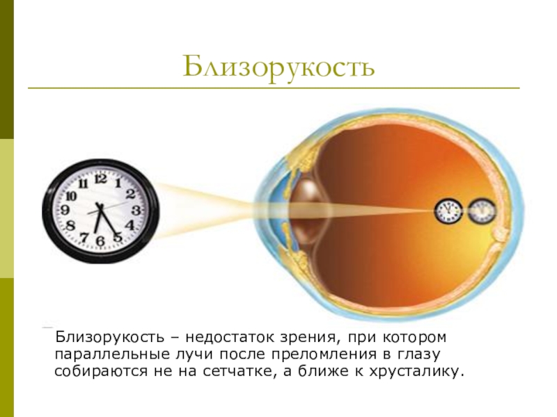 Дефект зрения презентация