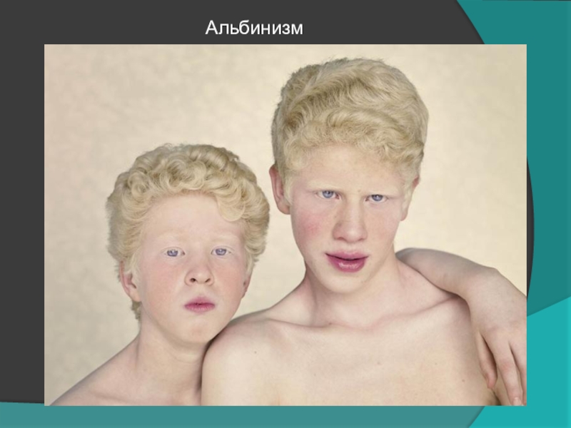 У человека курчавые волосы с доминируют. Альбинизм генная мутация. Альбинизм хромосомная мутация. Генетические заболевания альбинизм.