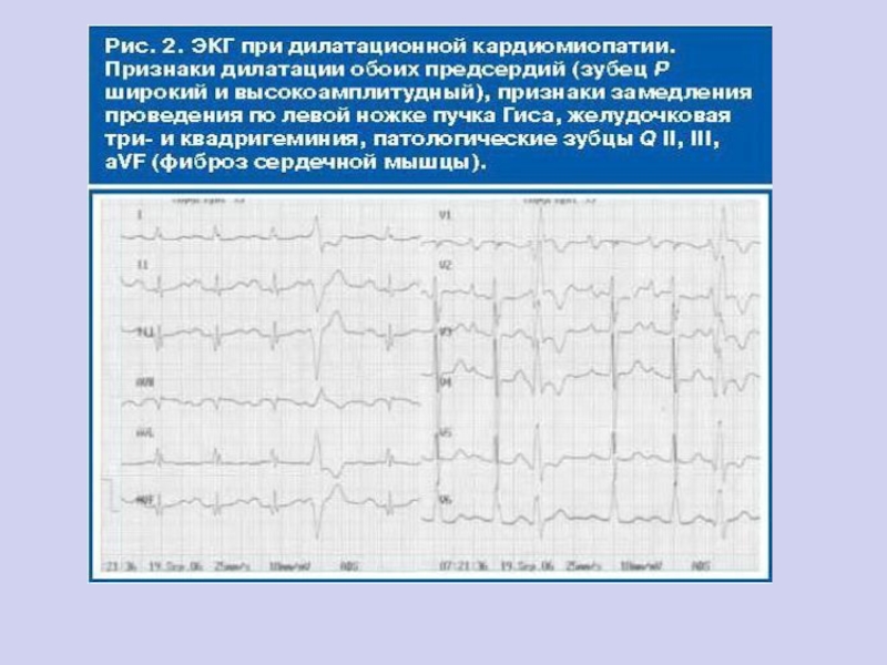 Экг при дилатационной кардиомиопатии фото