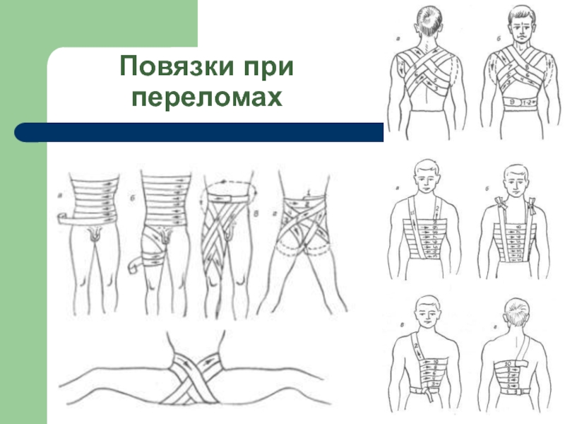 Этапы оказания первой помощи при переломе конечностей. Имоббилизпуия при переломов ребер. Иммобилизация конечности при переломе. Закрытый перелом первая медицинская помощь. Транспортная иммобилизация рисунок.