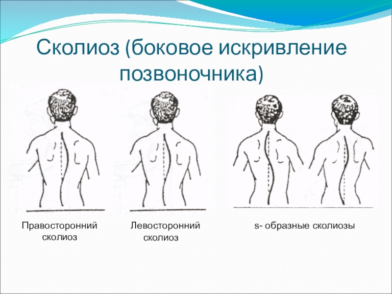 Задачи при сколиозе