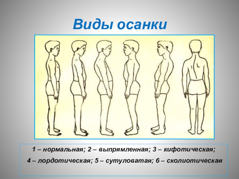 Рассмотрите рисунок к какому типу. Типы осанки человека. Нормальный Тип осанки. Кифотический Тип осанки. Типы нарушения осанки человека.