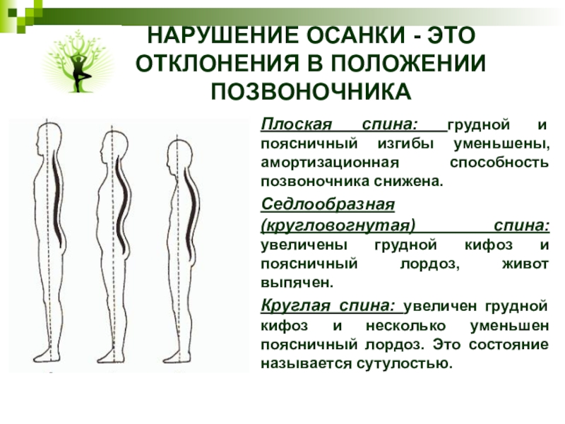 Нарушение осанки. Нарушение осанки плоская спина. Нарушение изгибов позвоночника. Нарушенная осанка.