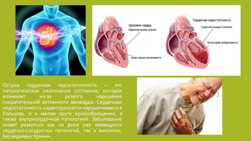Миокардиальная сердечная недостаточность