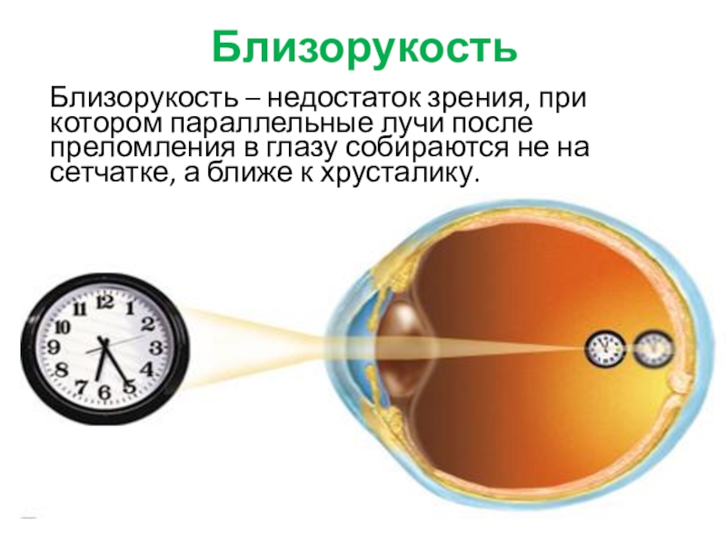 Презентация по физике близорукость