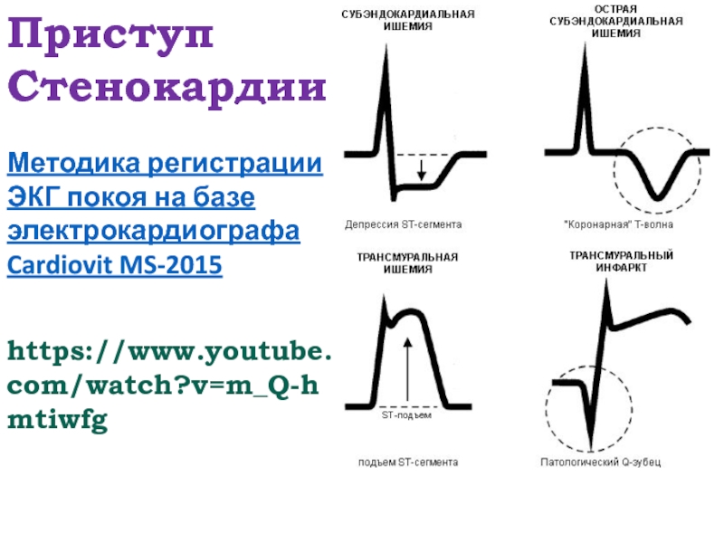 Регистрация экг. Приступ стенокардии на ЭКГ. ЭКГ при приступе стенокардии. Электрокардиография в покое. Физические основы электрокардиографии.